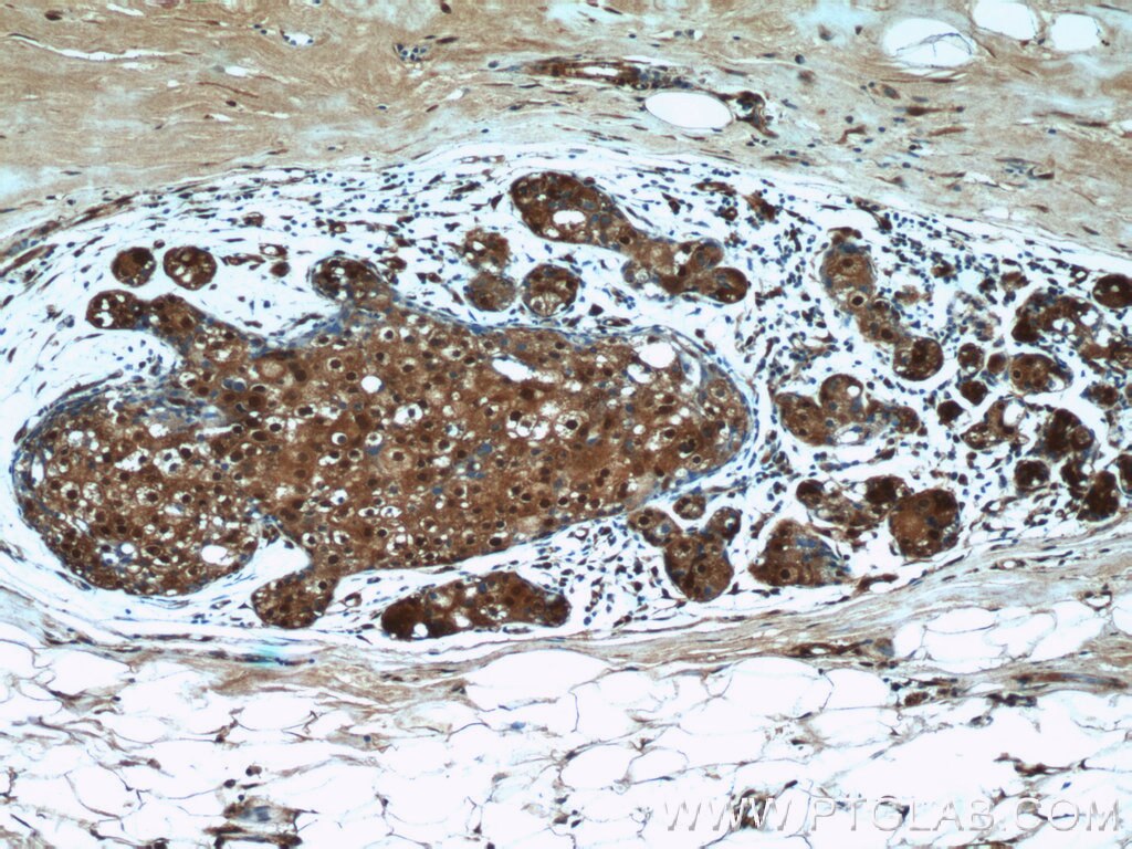 IHC staining of human breast cancer using 24058-1-AP