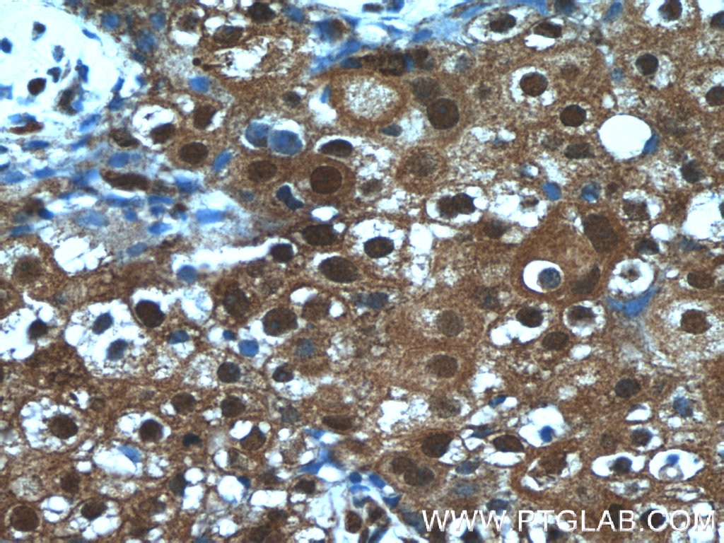 Immunohistochemistry (IHC) staining of human breast cancer tissue using ANKS3 Polyclonal antibody (24058-1-AP)