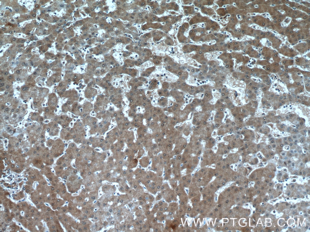 IHC staining of human hepatocirrhosis using 24058-1-AP