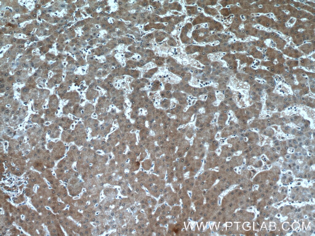 Immunohistochemistry (IHC) staining of human hepatocirrhosis tissue using ANKS3 Polyclonal antibody (24058-1-AP)