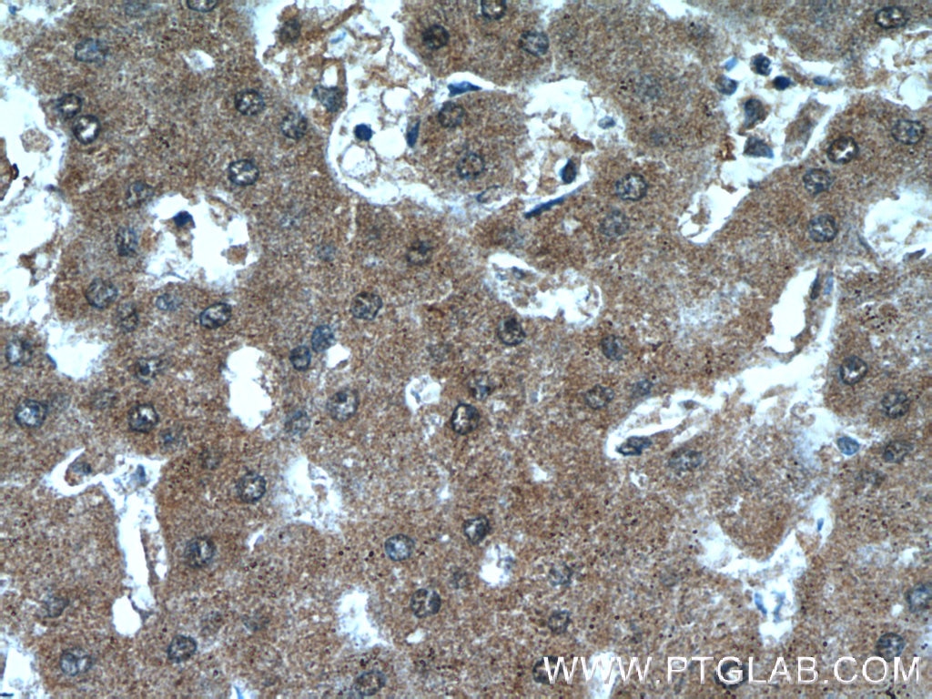 Immunohistochemistry (IHC) staining of human hepatocirrhosis tissue using ANKS3 Polyclonal antibody (24058-1-AP)