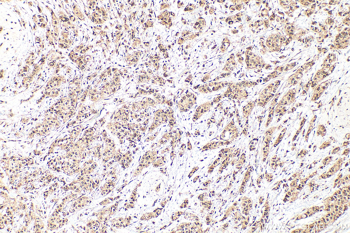 Immunohistochemistry (IHC) staining of human breast cancer tissue using ANKS3 Polyclonal antibody (24058-1-AP)