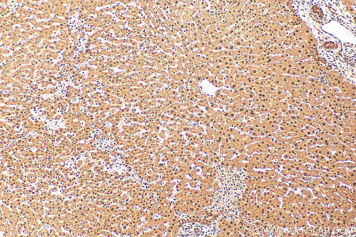 Immunohistochemistry (IHC) staining of human hepatocirrhosis tissue using ANKS3 Polyclonal antibody (24058-1-AP)