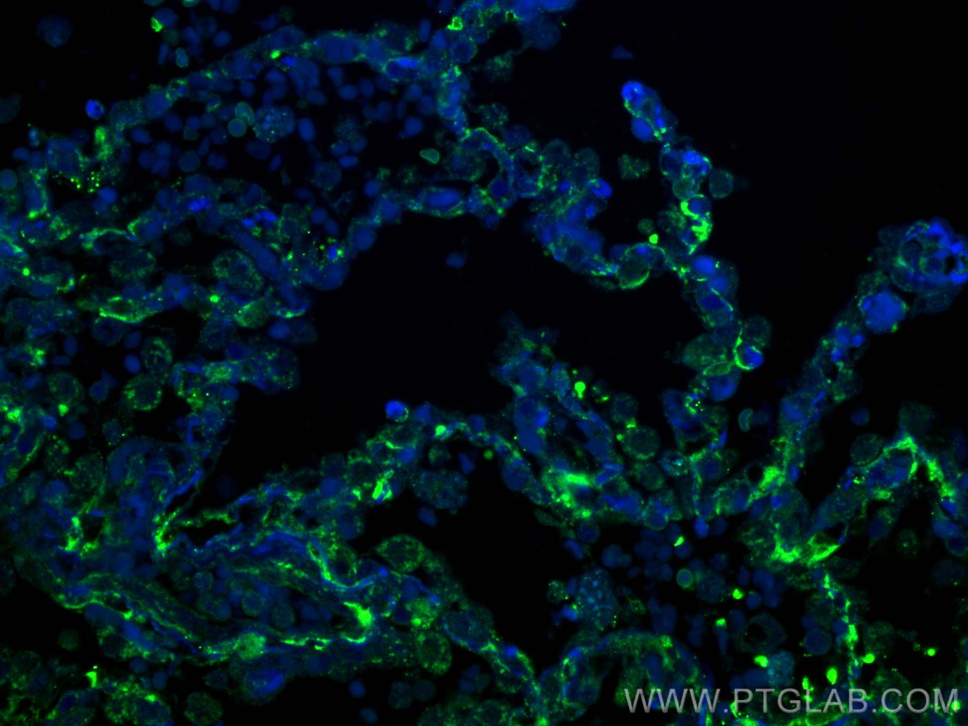 Immunofluorescence (IF) / fluorescent staining of human lung cancer tissue using TMEM16A/DOG1 Polyclonal antibody (12652-1-AP)