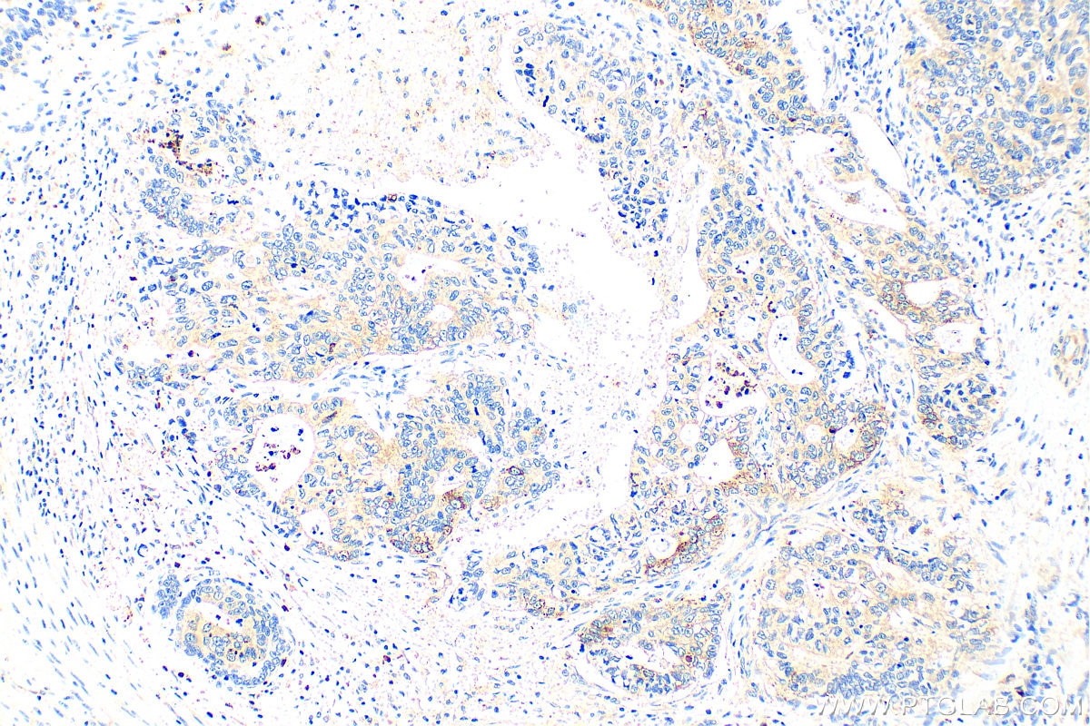 Immunohistochemistry (IHC) staining of human stomach cancer tissue using TMEM16A/DOG1 Polyclonal antibody (12652-1-AP)