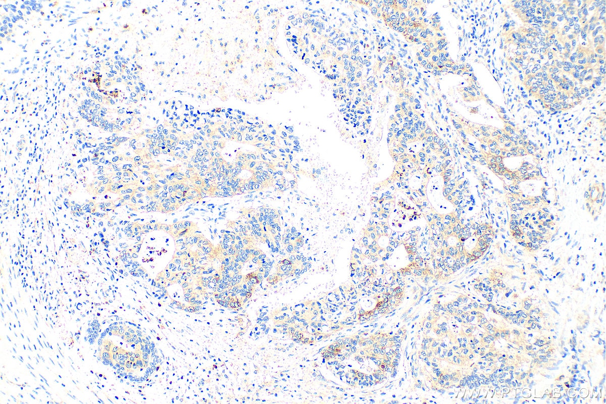 Immunohistochemistry (IHC) staining of human stomach cancer tissue using TMEM16A Polyclonal antibody (12652-1-AP)