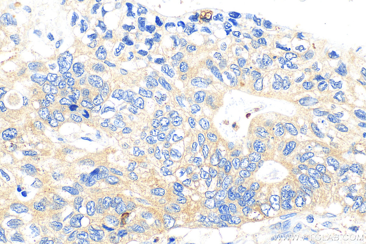 Immunohistochemistry (IHC) staining of human stomach cancer tissue using TMEM16A Polyclonal antibody (12652-1-AP)