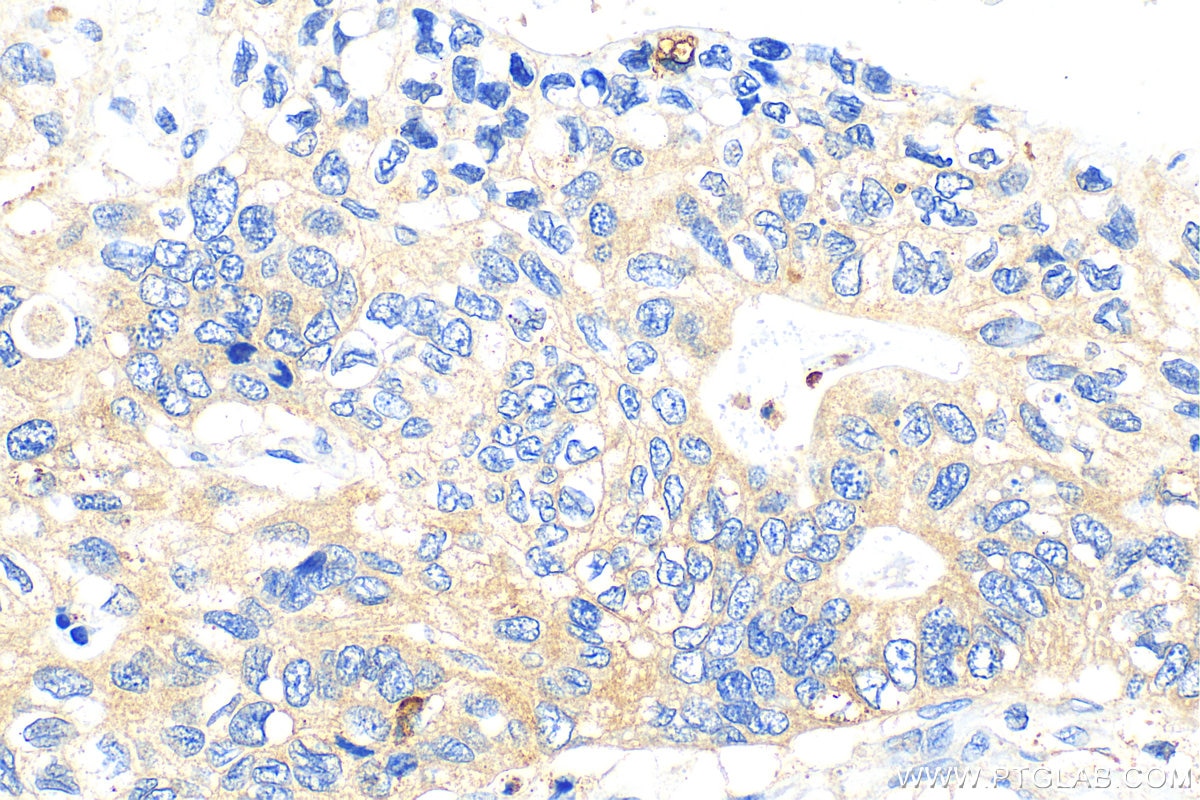 IHC staining of human stomach cancer using 12652-1-AP