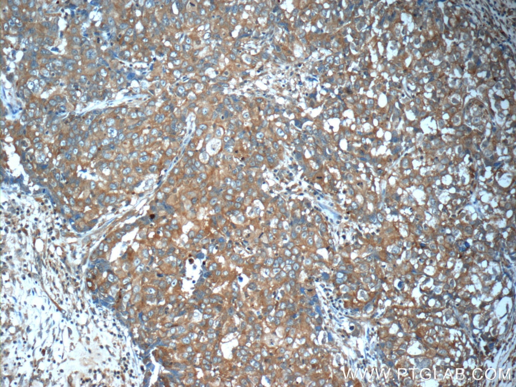 Immunohistochemistry (IHC) staining of human breast cancer tissue using ANO2 Polyclonal antibody (20647-1-AP)