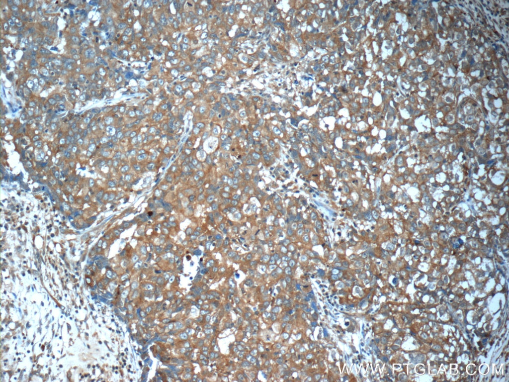 Immunohistochemistry (IHC) staining of human breast cancer tissue using ANO2 Polyclonal antibody (20647-1-AP)
