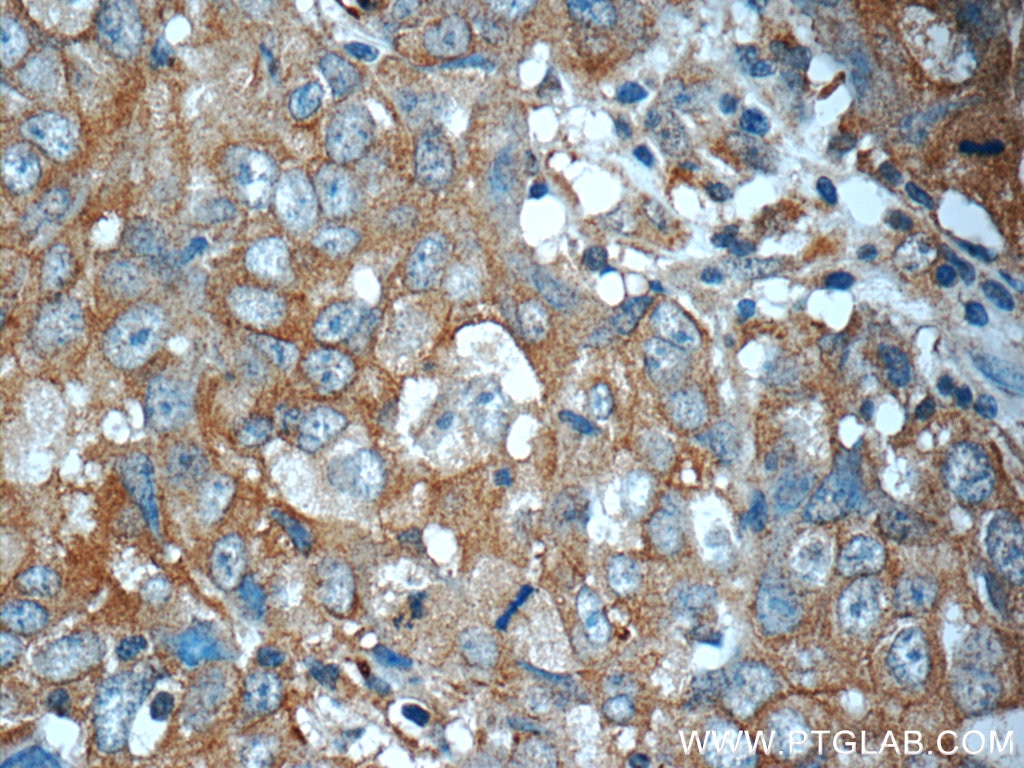 Immunohistochemistry (IHC) staining of human breast cancer tissue using ANO2 Polyclonal antibody (20647-1-AP)