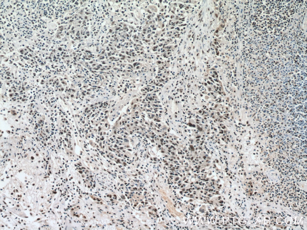 Immunohistochemistry (IHC) staining of human colon cancer tissue using ANP32B Polyclonal antibody (10843-1-AP)