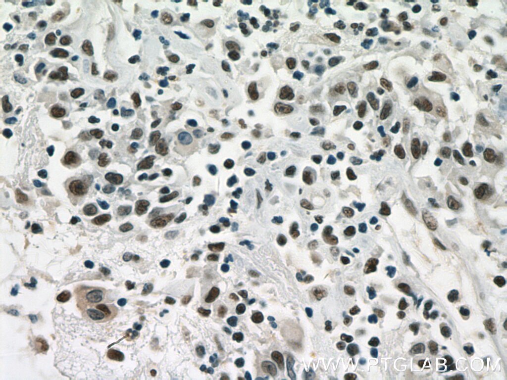 Immunohistochemistry (IHC) staining of human colon cancer tissue using ANP32B Polyclonal antibody (10843-1-AP)