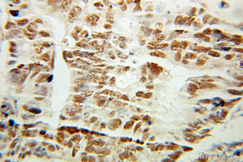 Immunohistochemistry (IHC) staining of human colon cancer tissue using ANP32B Polyclonal antibody (10843-1-AP)