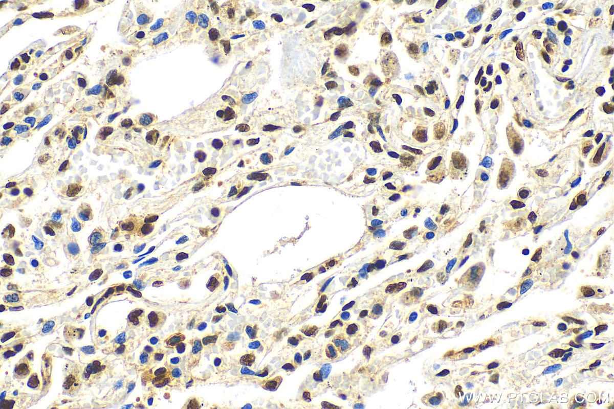 Immunohistochemistry (IHC) staining of human lung tissue using ANP32E Polyclonal antibody (31989-1-AP)