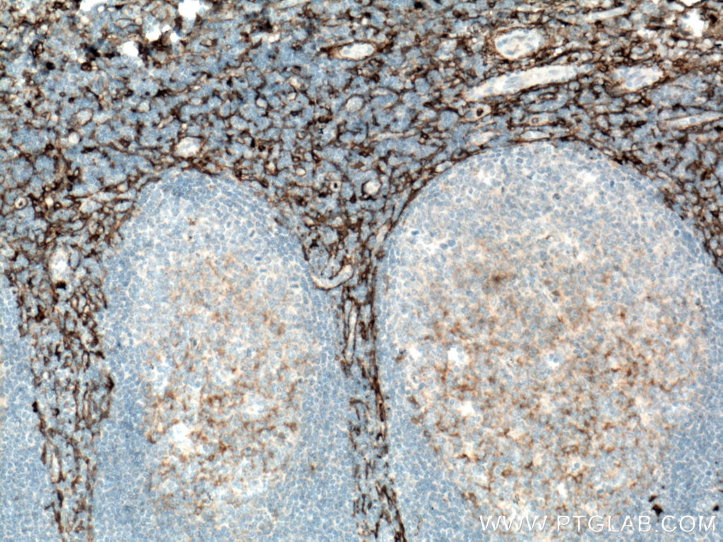 IHC staining of human tonsillitis using 14553-1-AP