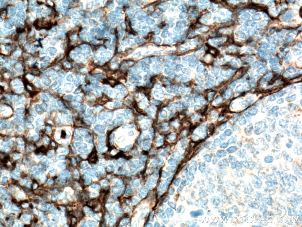 Immunohistochemistry (IHC) staining of human tonsillitis tissue using CD13 Polyclonal antibody (14553-1-AP)