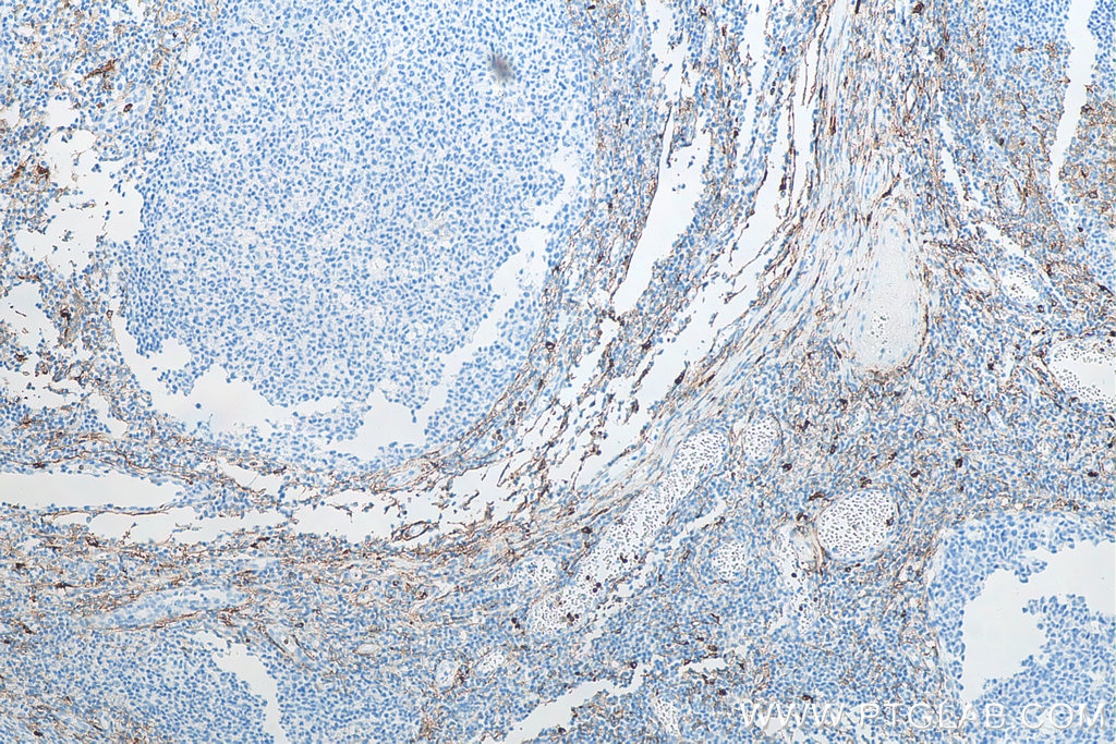 IHC staining of human tonsillitis using 66211-1-Ig