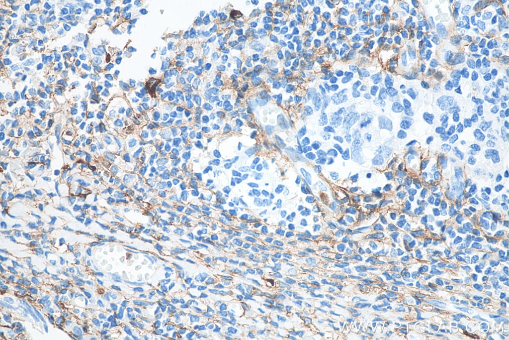 Immunohistochemistry (IHC) staining of human tonsillitis tissue using CD13 Monoclonal antibody (66211-1-Ig)