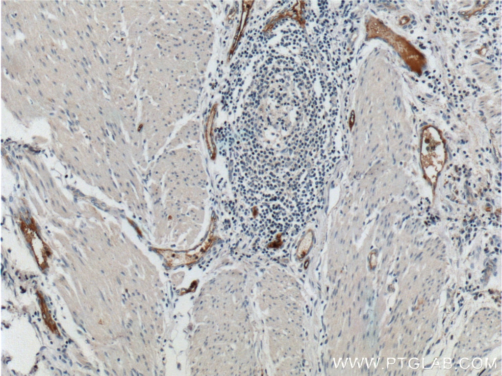 IHC staining of human colon cancer using 15091-1-AP