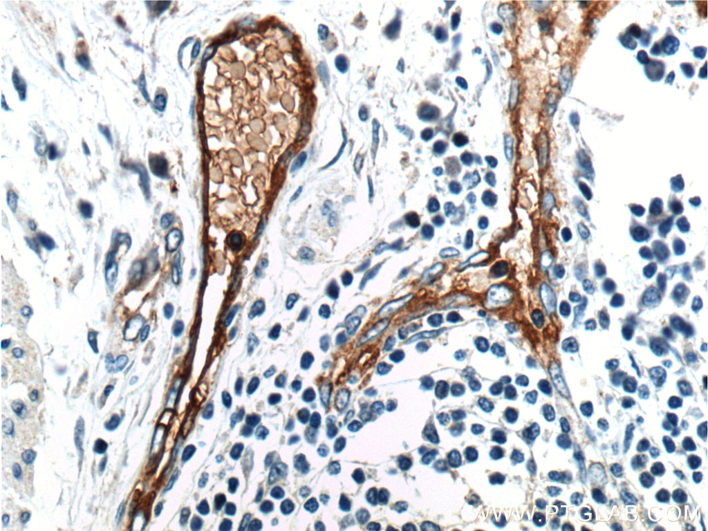 Immunohistochemistry (IHC) staining of human colon cancer tissue using ANTXR1 Polyclonal antibody (15091-1-AP)