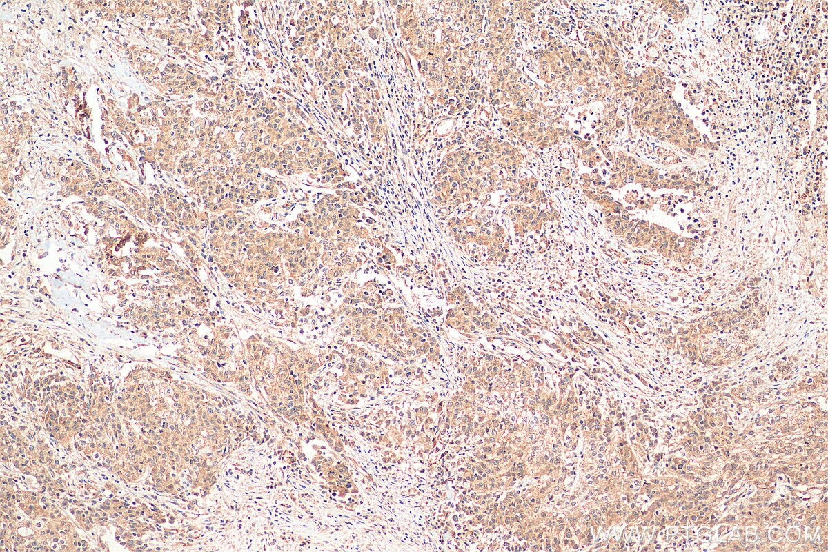 Immunohistochemistry (IHC) staining of human stomach cancer tissue using ANUBL1 Polyclonal antibody (17478-1-AP)