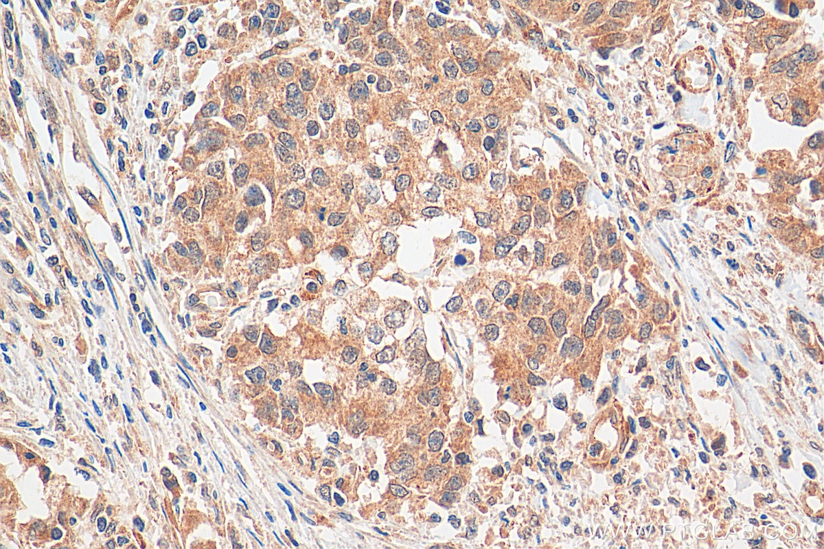 Immunohistochemistry (IHC) staining of human stomach cancer tissue using ANUBL1 Polyclonal antibody (17478-1-AP)