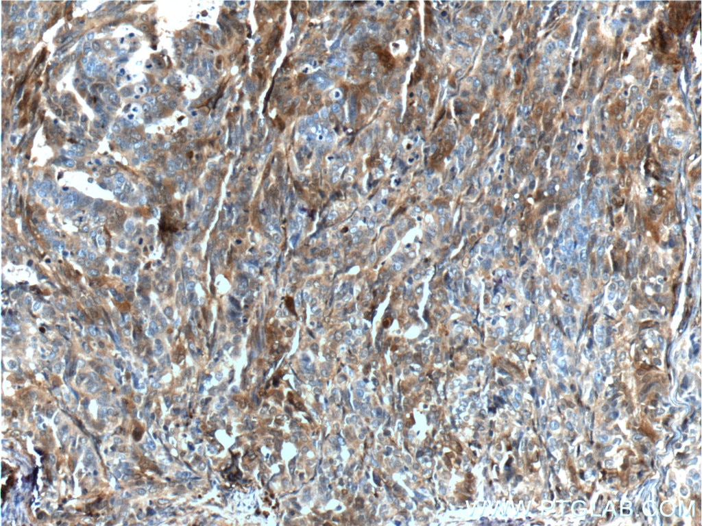 Immunohistochemistry (IHC) staining of human ovary tumor tissue using Annexin A1 Polyclonal antibody (21990-1-AP)
