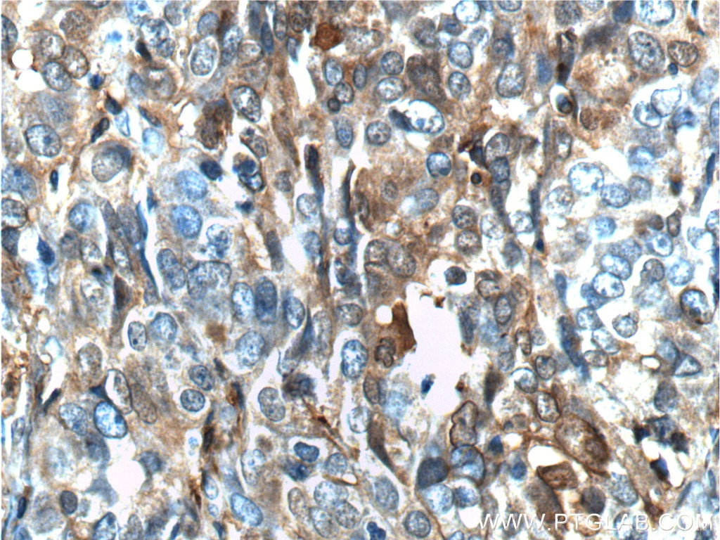 Immunohistochemistry (IHC) staining of human ovary tumor tissue using Annexin A1 Polyclonal antibody (21990-1-AP)