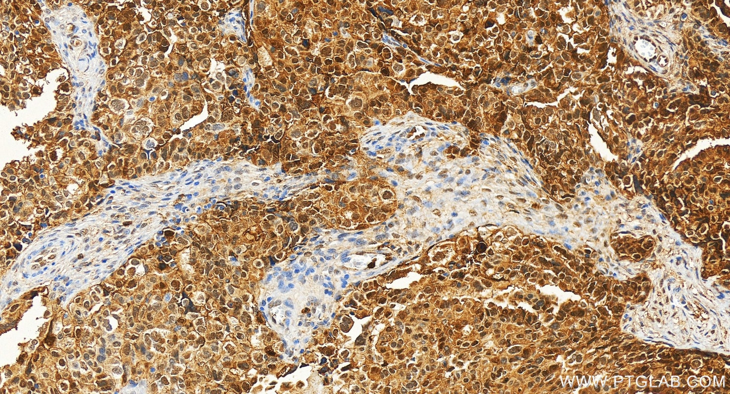 Immunohistochemistry (IHC) staining of human ovary cancer tissue using Annexin A1 Polyclonal antibody (21990-1-AP)