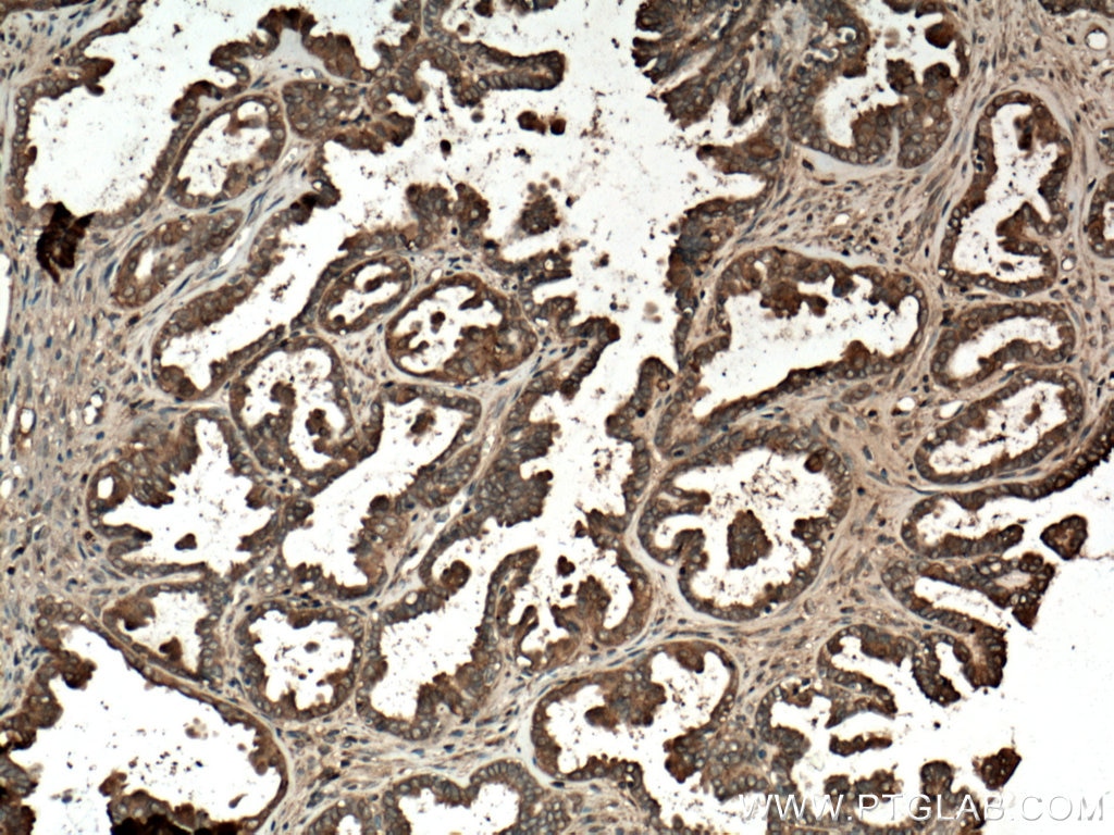 Immunohistochemistry (IHC) staining of human ovary tumor tissue using Annexin A11 Polyclonal antibody (10479-2-AP)