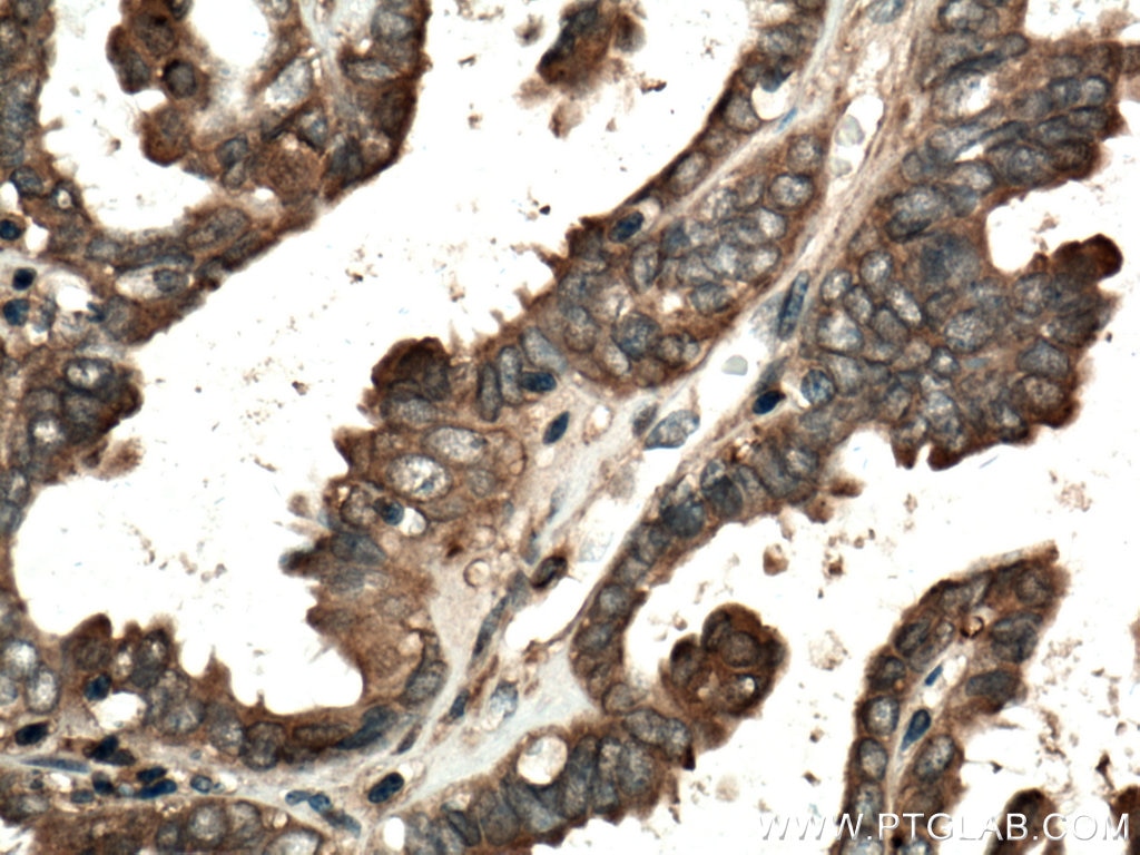 Immunohistochemistry (IHC) staining of human ovary tumor tissue using Annexin A11 Polyclonal antibody (10479-2-AP)