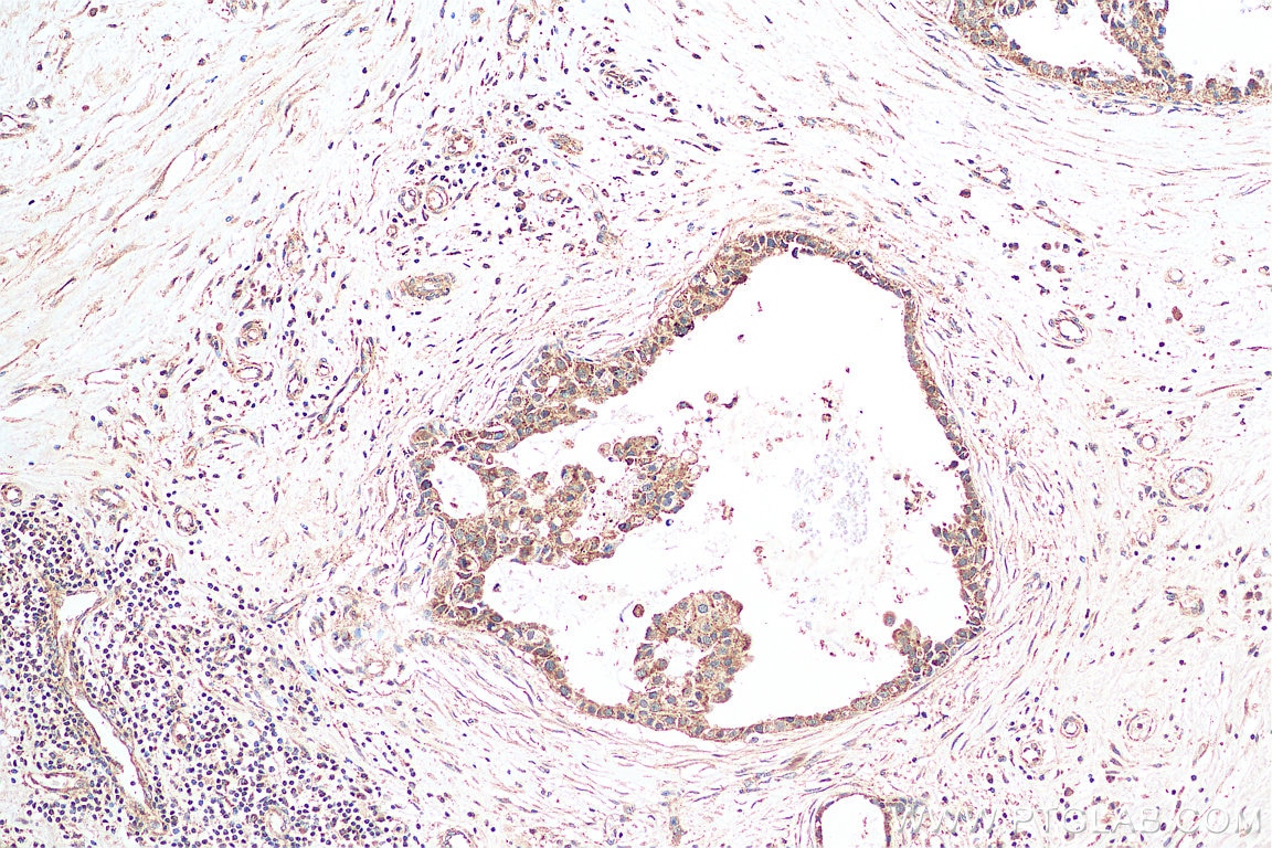 Immunohistochemistry (IHC) staining of human breast cancer tissue using Annexin A11 Polyclonal antibody (10479-2-AP)