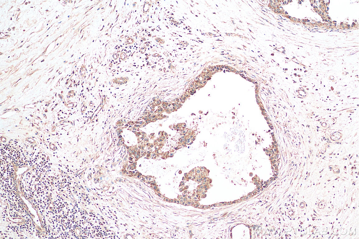 IHC staining of human breast cancer using 10479-2-AP