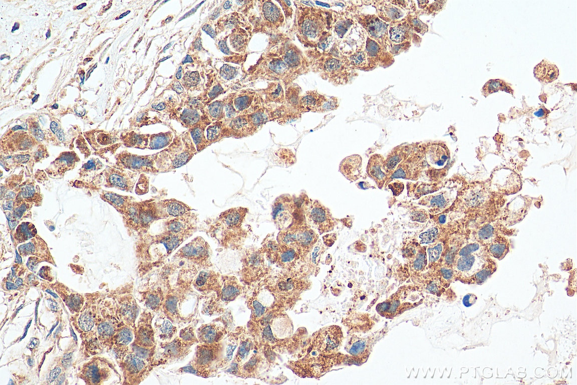 Immunohistochemistry (IHC) staining of human breast cancer tissue using Annexin A11 Polyclonal antibody (10479-2-AP)