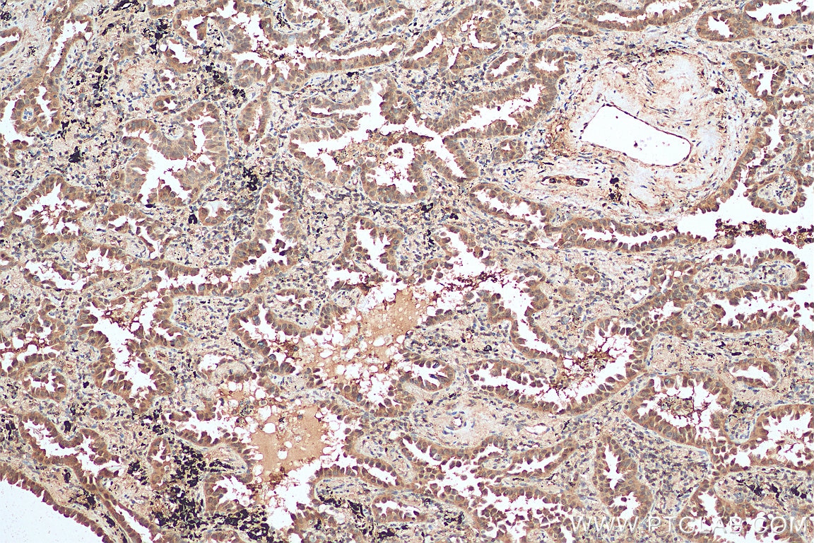 Immunohistochemistry (IHC) staining of human lung cancer tissue using Annexin A11 Polyclonal antibody (10479-2-AP)