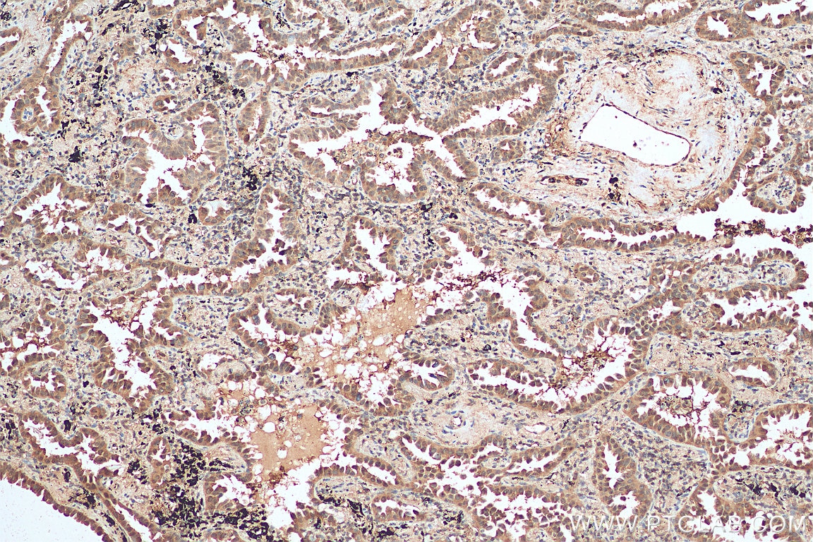 IHC staining of human lung cancer using 10479-2-AP