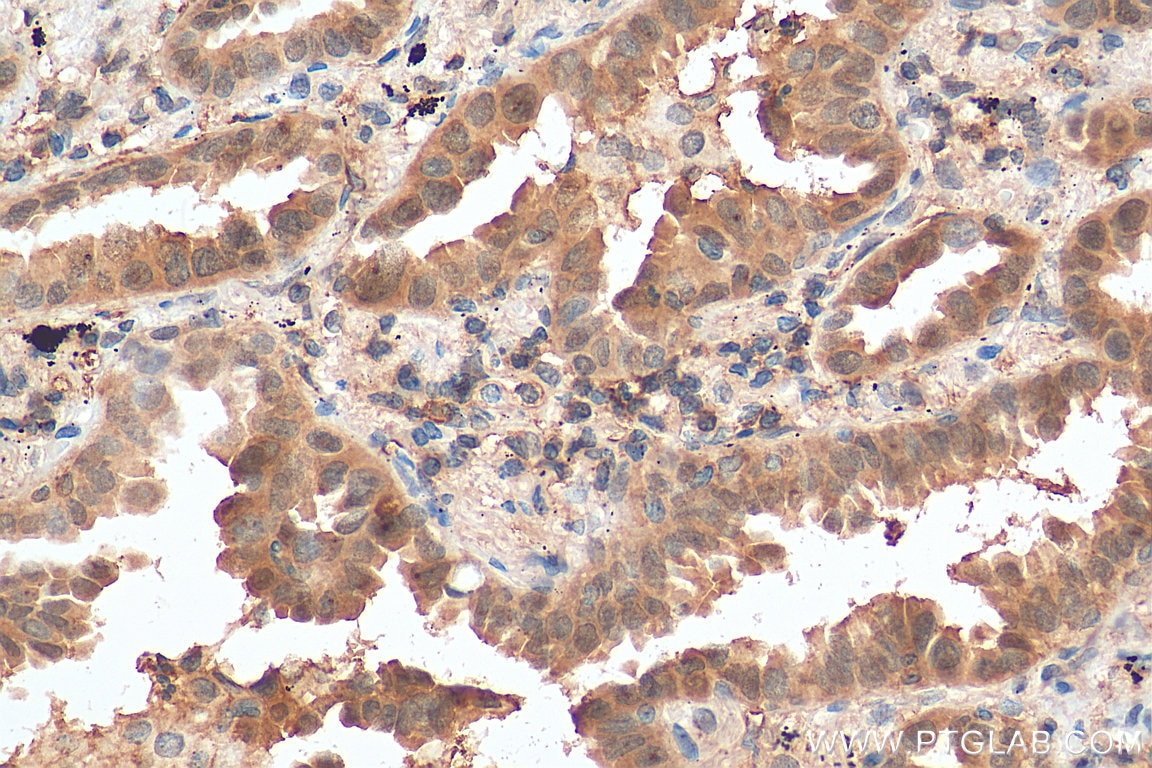 Immunohistochemistry (IHC) staining of human lung cancer tissue using Annexin A11 Polyclonal antibody (10479-2-AP)