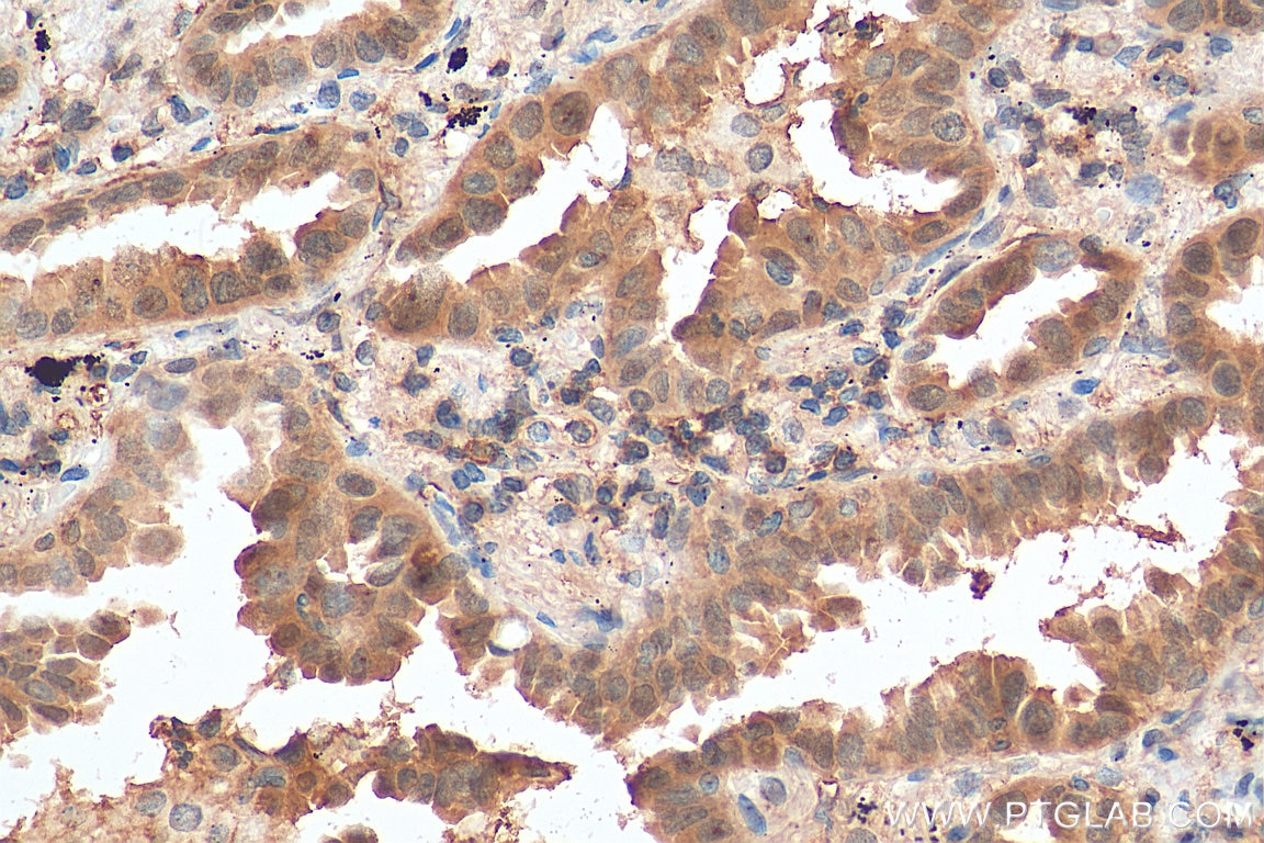 IHC staining of human lung cancer using 10479-2-AP