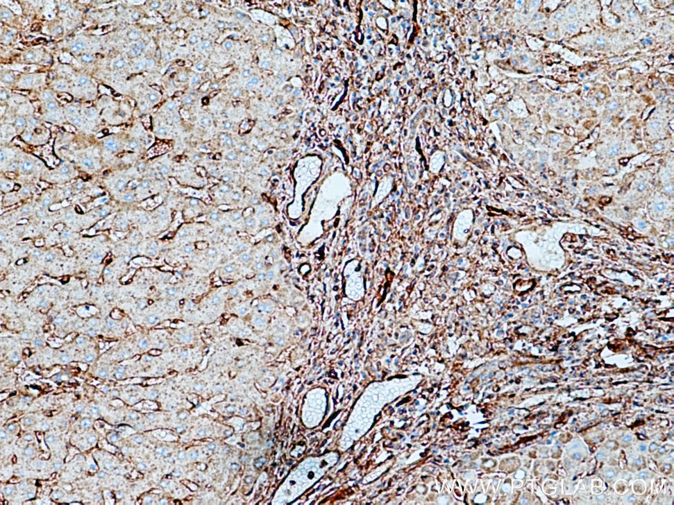 Immunohistochemistry (IHC) staining of human hepatocirrhosis tissue using Annexin A2 Polyclonal antibody (11256-1-AP)