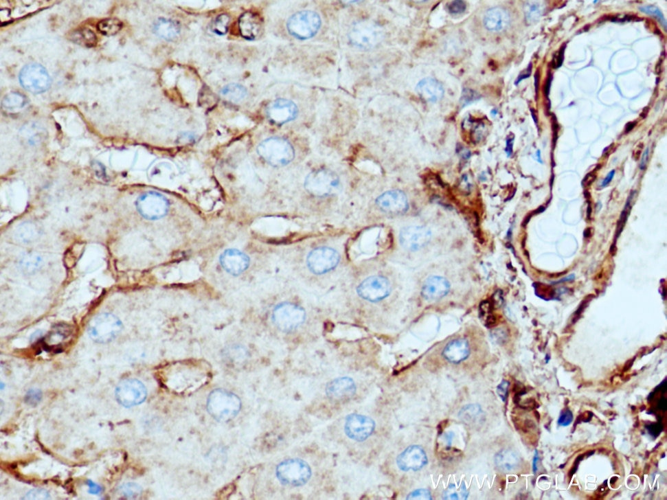 IHC staining of human hepatocirrhosis using 11256-1-AP