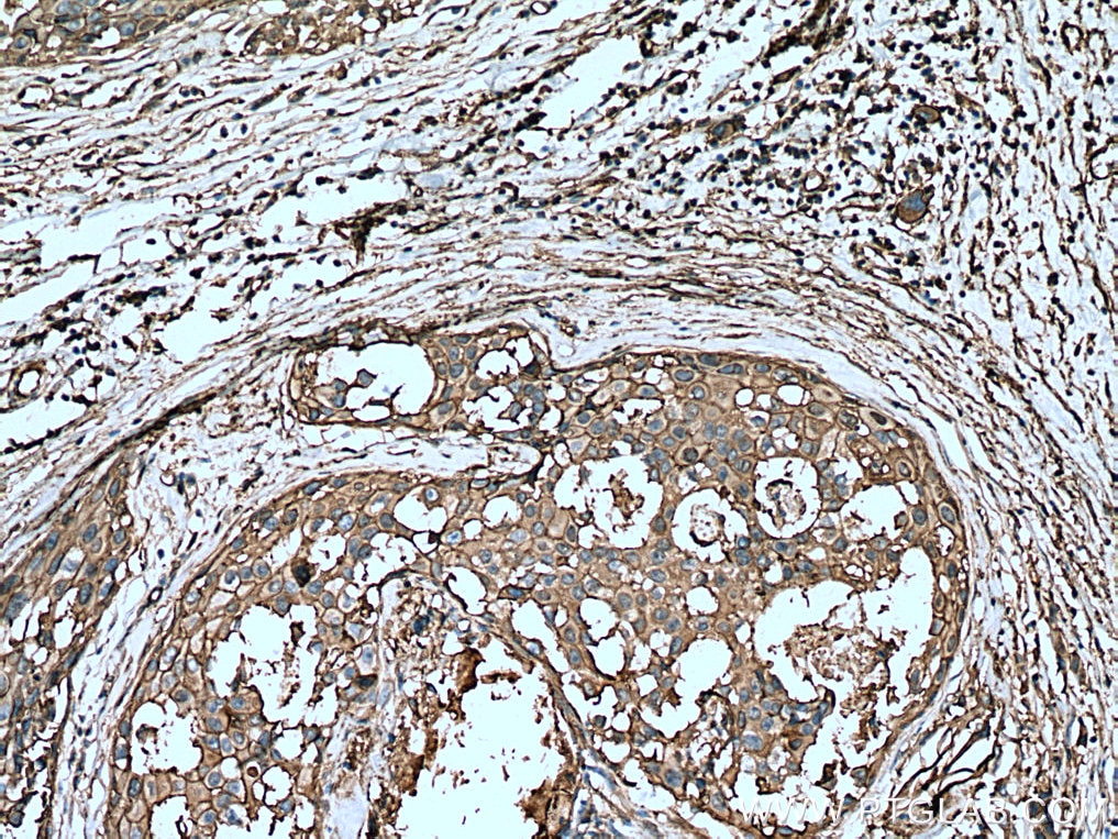 Immunohistochemistry (IHC) staining of human breast cancer tissue using Annexin A2 Polyclonal antibody (11256-1-AP)