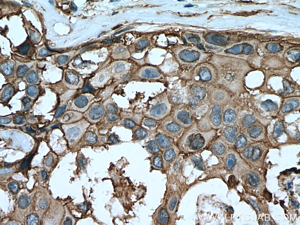 Immunohistochemistry (IHC) staining of human breast cancer tissue using Annexin A2 Polyclonal antibody (11256-1-AP)