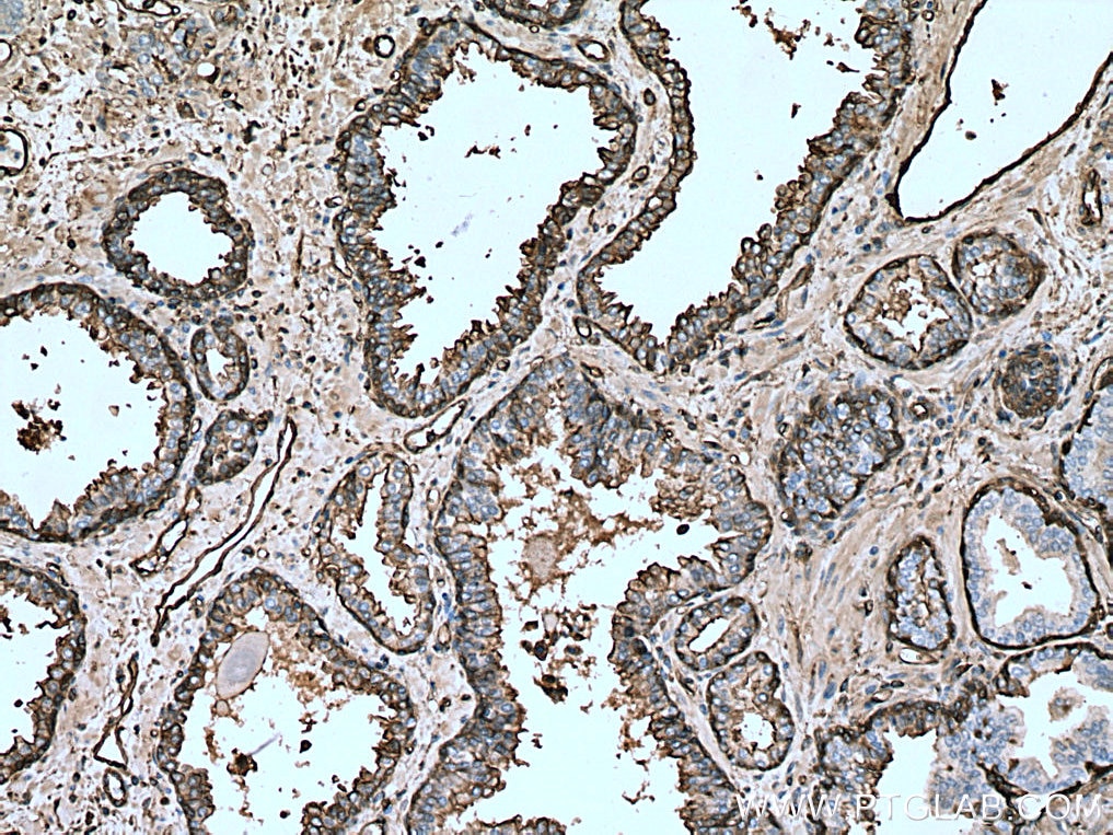 Immunohistochemistry (IHC) staining of human prostate cancer tissue using Annexin A2 Polyclonal antibody (11256-1-AP)