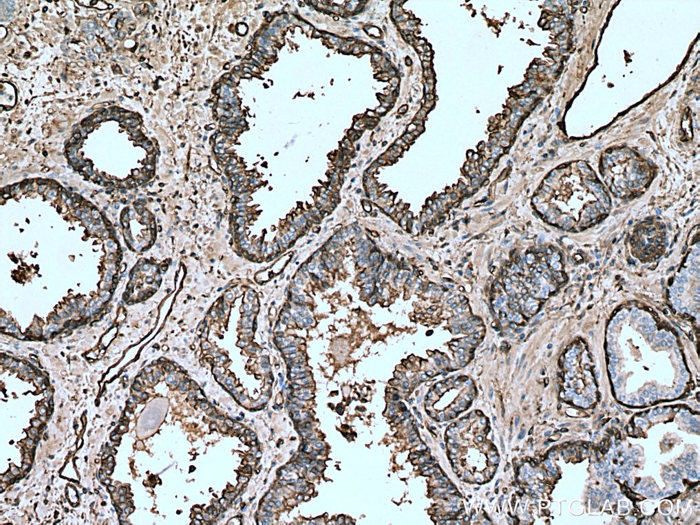 IHC staining of human prostate cancer using 11256-1-AP