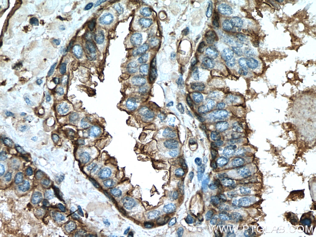 Immunohistochemistry (IHC) staining of human prostate cancer tissue using Annexin A2 Polyclonal antibody (11256-1-AP)