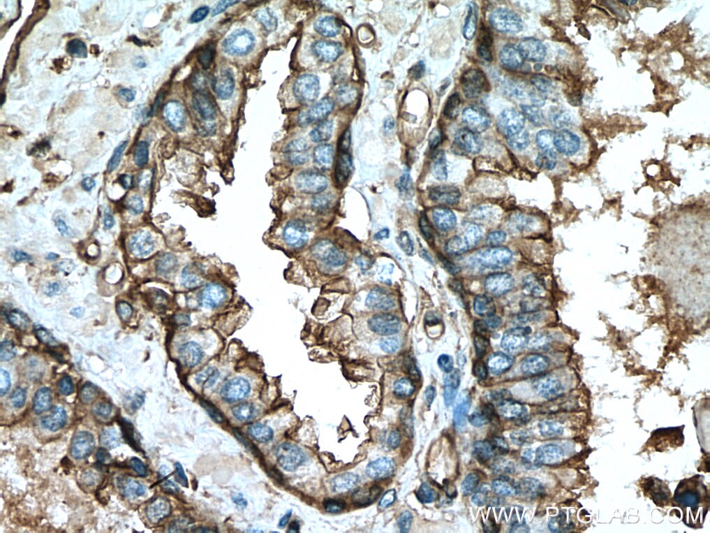 Immunohistochemistry (IHC) staining of human prostate cancer tissue using Annexin A2 Polyclonal antibody (11256-1-AP)