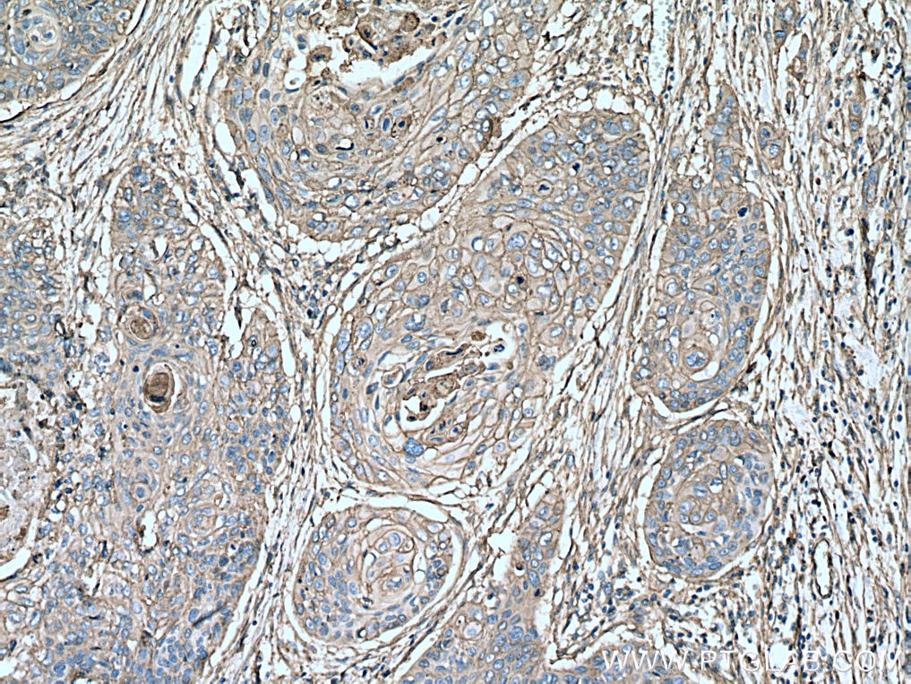 IHC staining of human oesophagus cancer using 11256-1-AP