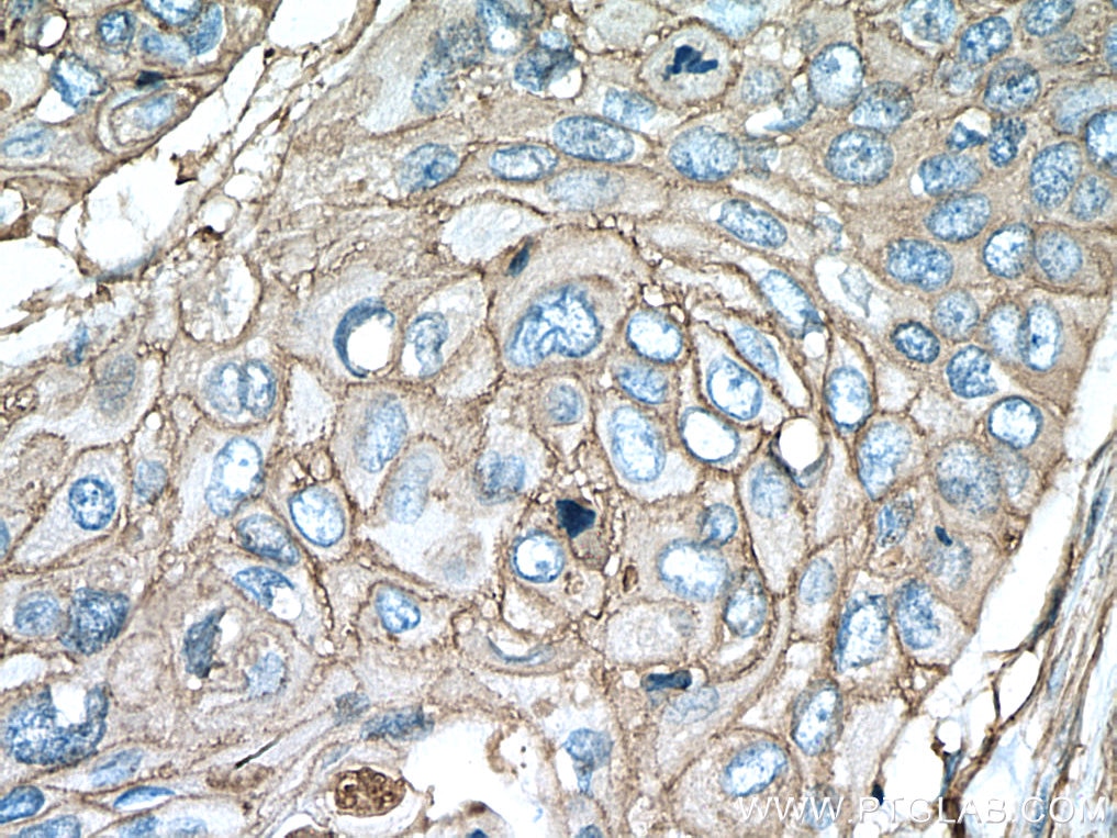 Immunohistochemistry (IHC) staining of human oesophagus cancer tissue using Annexin A2 Polyclonal antibody (11256-1-AP)