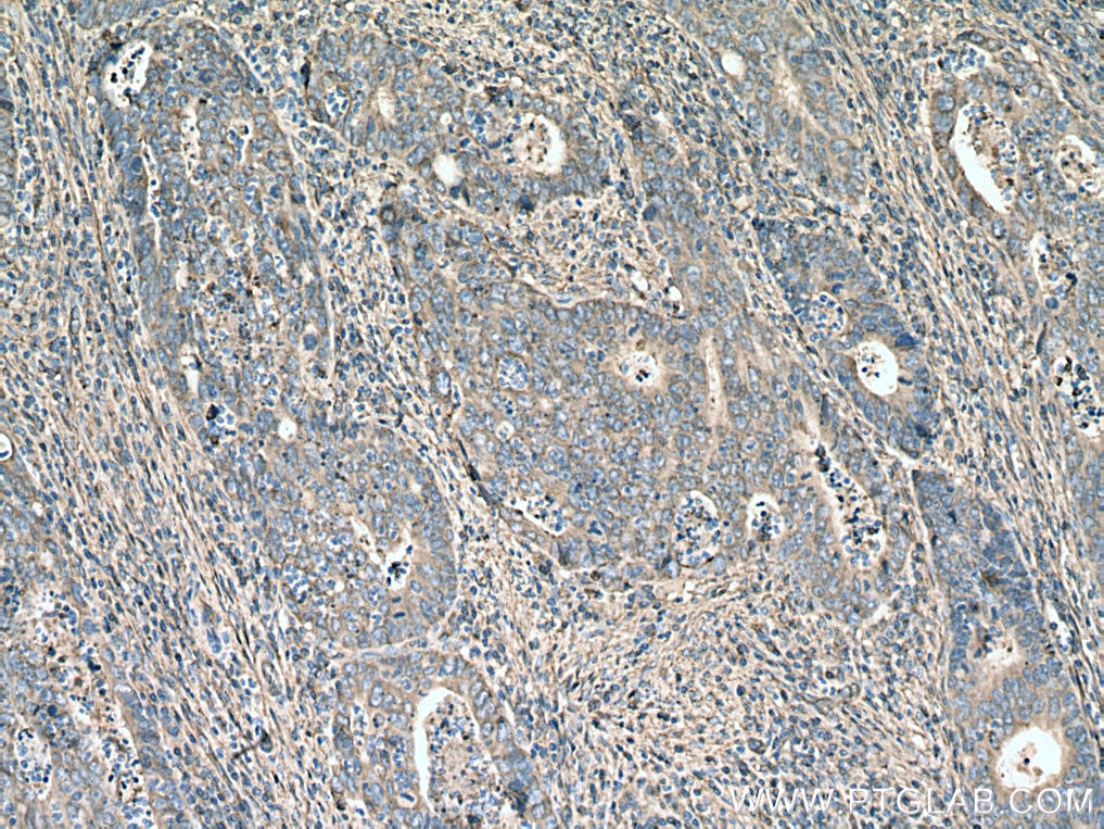 Immunohistochemistry (IHC) staining of human colon cancer tissue using Annexin A2 Polyclonal antibody (11256-1-AP)